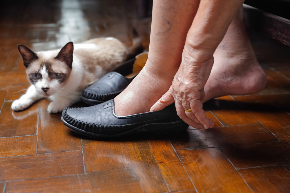 Swollen ankles of an elderly women with a cat in background