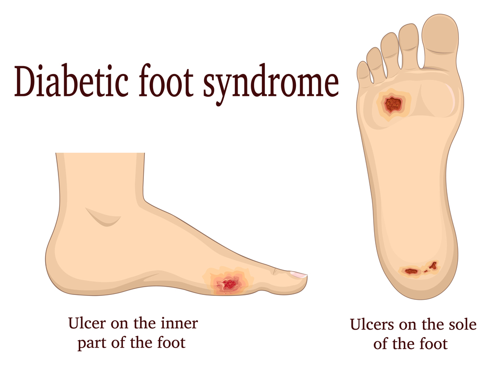 A vector image of diabetic foot syndrome and wound care