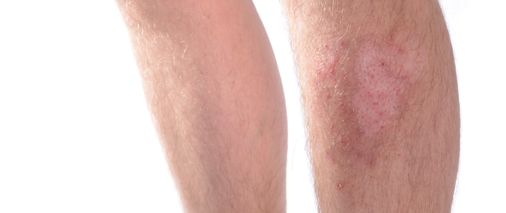 Male legs with skin infection