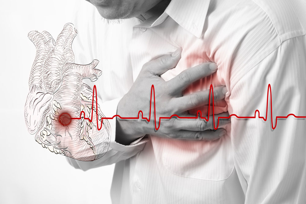 Heart attack and heart beats cardiogram