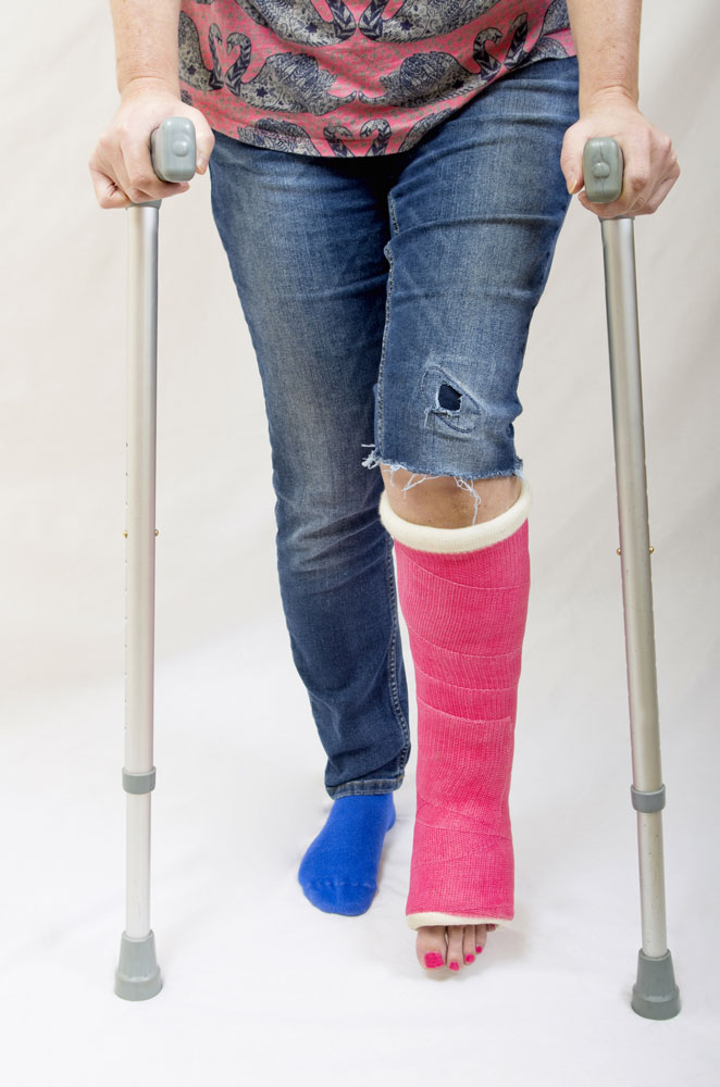 Women with broken leg bone and crutches