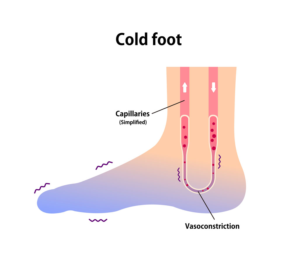 Vector demonstrating poor blood circulation because of cold foot