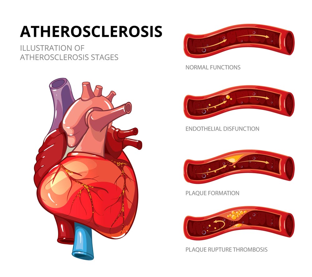 Atherosclerosis Symptoms & Stages Illustration