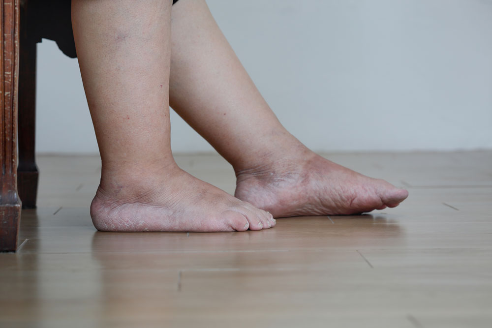 Elderly women with leg swelling