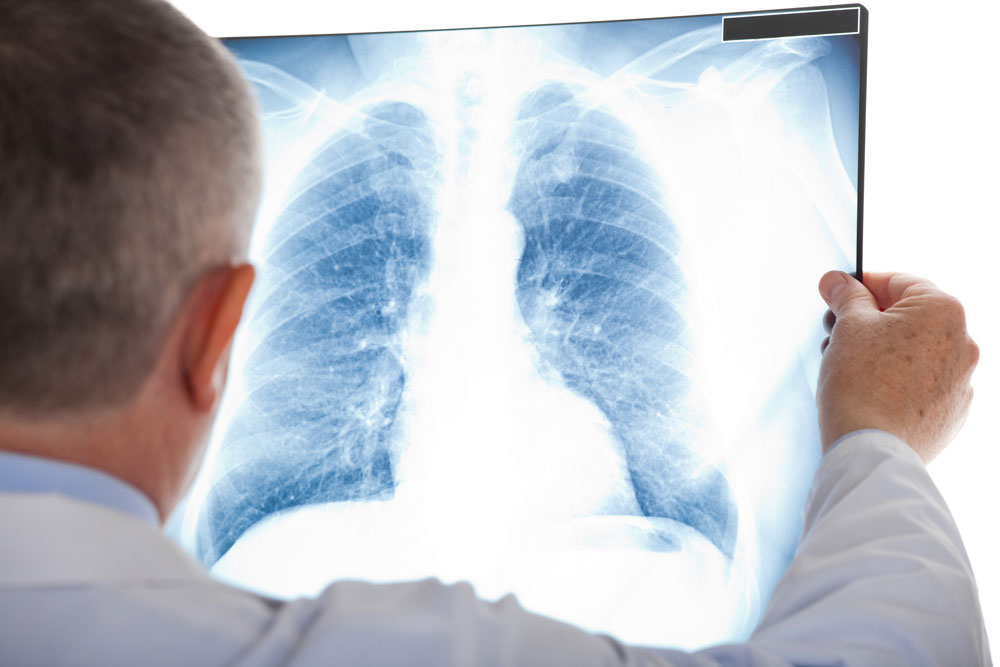 Doctor examining a lung radiography to see if the patient have chest infection