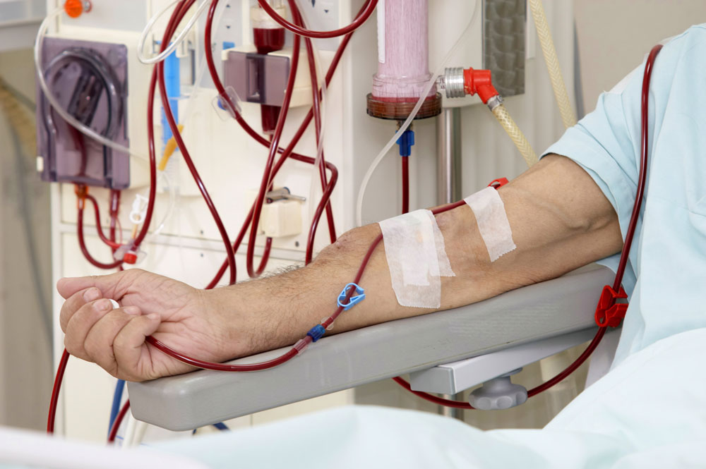 Purifying blood using dialysis treatment