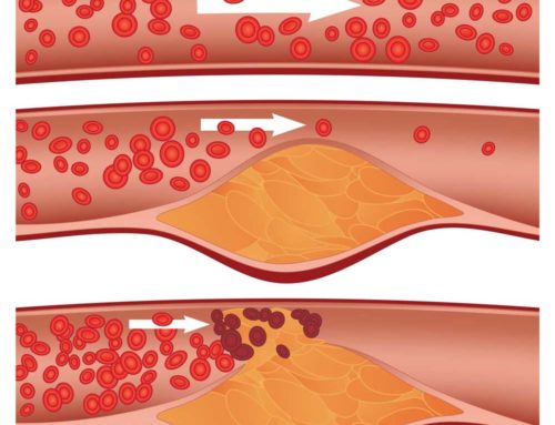 How Long Can You Live with Blocked Arteries?