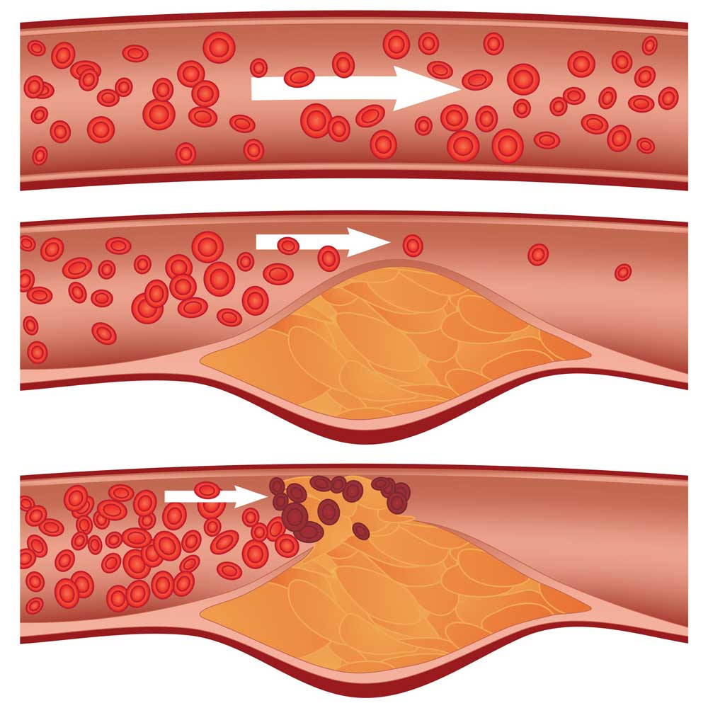 Visual representation of cholesterol plaque causing blocked arteries.