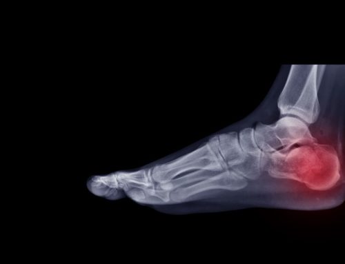 A Broken Ankle: Things To Avoid Doing