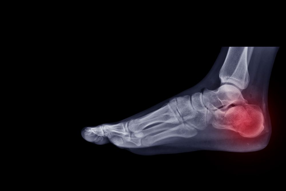 An Xray of foot highlighting broken ankle.