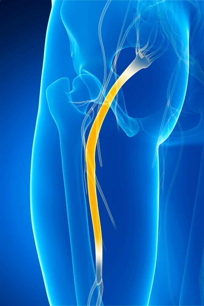 Illustration of Sciatic Nerve Pain